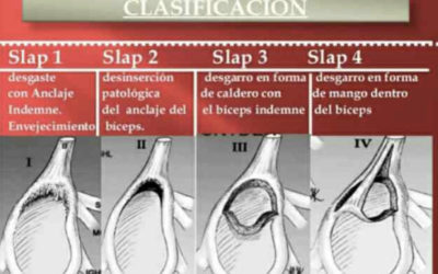 LESIÓN DE SLAP